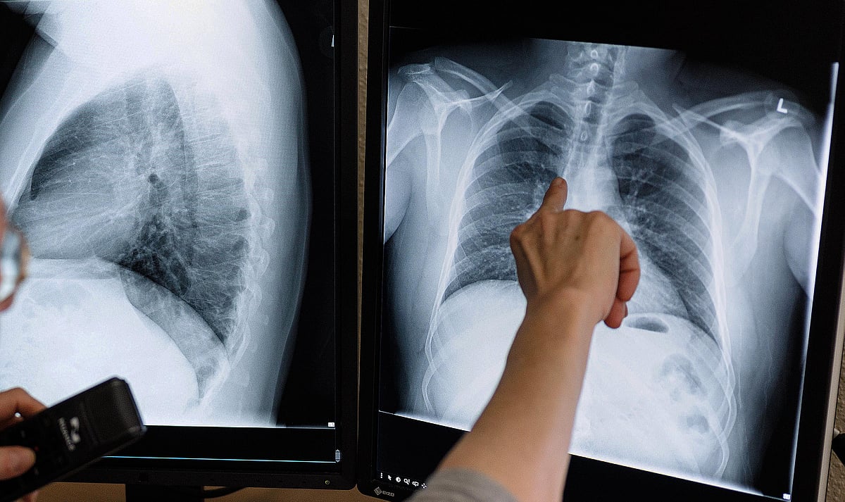 Delhi is India's TB capital; Gujarat least affected state