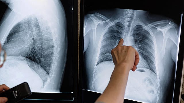 Delhi is India's TB capital; Gujarat least affected state Delhi is India's TB capital; Gujarat least affected state