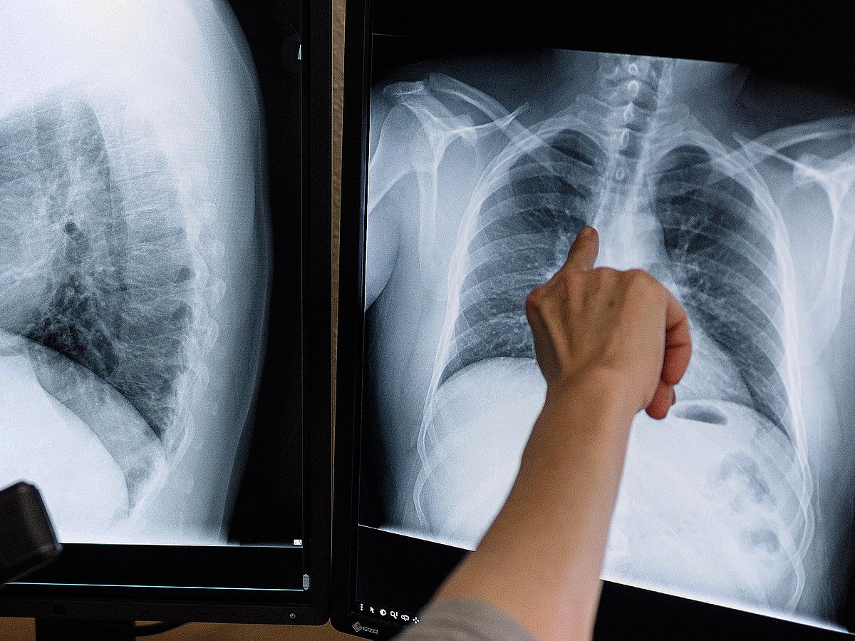 The prevalence of TB infection among the population aged 15 years or more is 31.4%. 