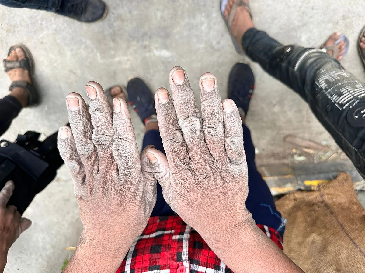 The NCPCR team that rescued child labourers found burn marks on their hands.